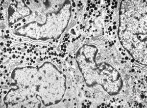 M, 16y. | acidophilic pituitary adenoma (STH